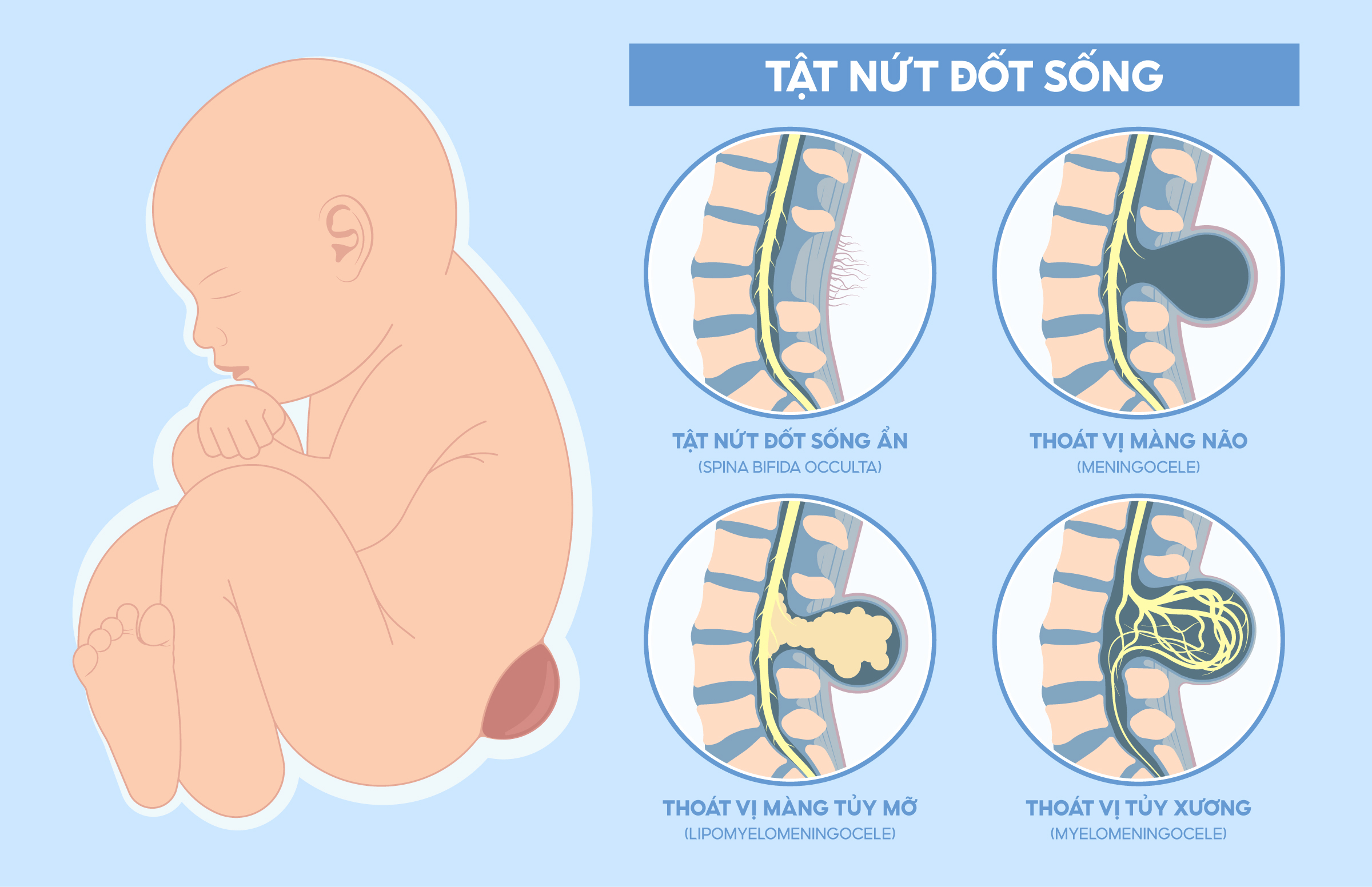 Acid folic ngăn dị tật đốt sống